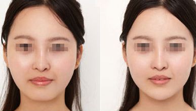 顴骨高如何改善臉型？假發(fā)光、真為你講解不同方法！