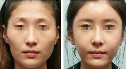 腹部抽脂減肥：注意事項與風(fēng)險揭秘