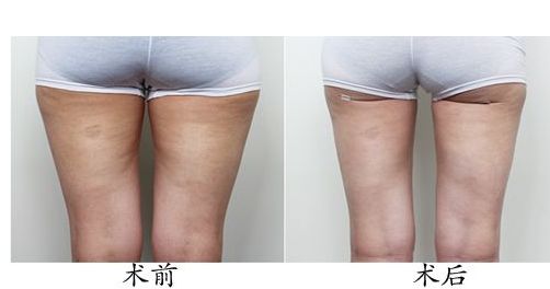 體驗(yàn)光子嫩膚，解密北京光子嫩膚價(jià)格