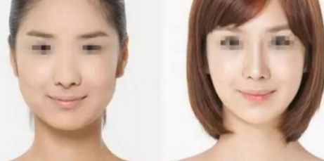 雙眼皮修復(fù)術(shù)最佳時(shí)機(jī)是什么時(shí)候？