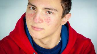 如何消除背部痘痘？最佳祛痘方法揭秘！