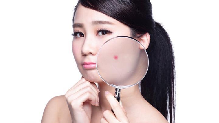 男士祛痘攻略：探索男性祛痘的有效方法