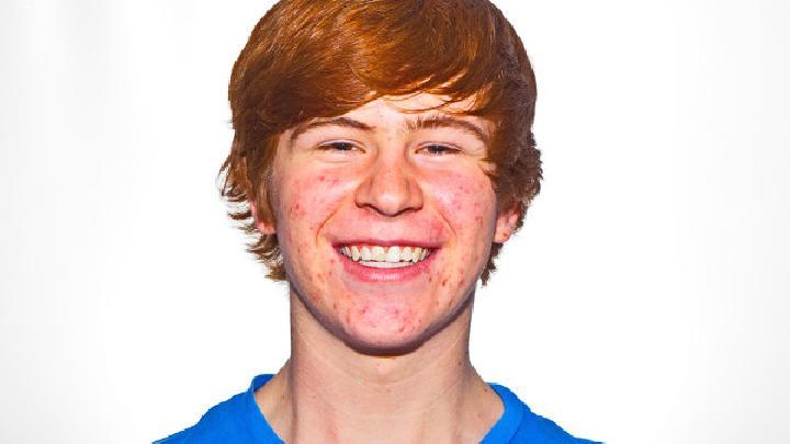 青少年如何有效祛痘美白？分享快速清除痘痘和淡化痘印的方法