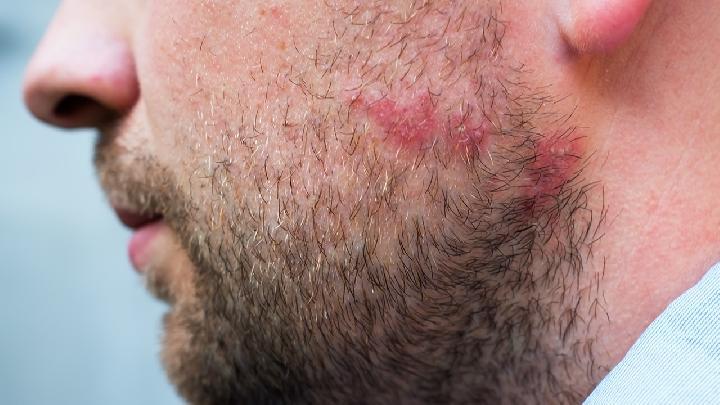 青春痘的去除，激光祛痘是怎么做的呢