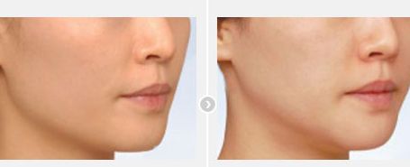 北京最受歡迎的雙眼皮修復(fù)醫(yī)生，多位滿意的患者推薦！