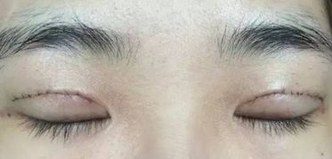 上海王會勇醫(yī)生鼻部整形案例分享：創(chuàng)新技術(shù)助您獲得完美鼻型！