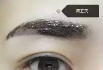 南昌美伊爾劉立軍醫(yī)生膨體隆鼻整形費(fèi)用？手術(shù)效果如何？帶您看醫(yī)生案例