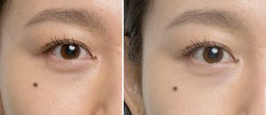 董玉林醫(yī)生的整形收費(fèi)標(biāo)準(zhǔn)及隆胸案例分享