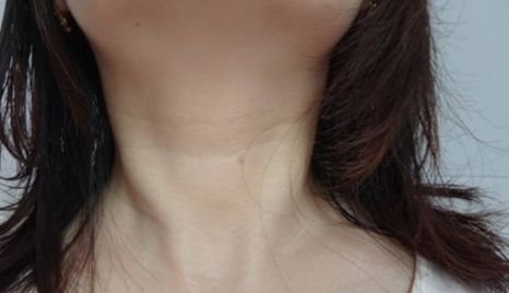 江華教授隆胸術，口碑與收費詳解