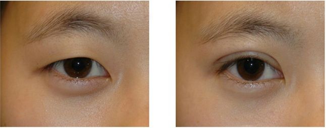 昆明哪家整形醫(yī)院做隆鼻修復(fù)效果好？