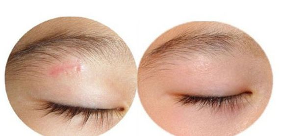 廣州曙光醫(yī)院雙眼皮手術(shù)手藝高超，名醫(yī)推薦！附真實案例！