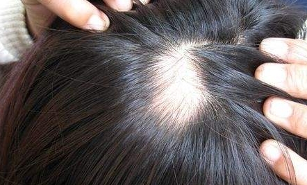 南京新生醫(yī)院植發(fā)效果如何？坐診專家簡介、詳細(xì)地址一覽