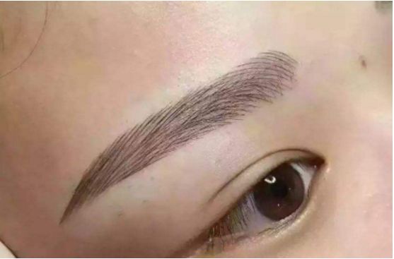 武漢葉子榮做拉皮的療效如何？專家醫(yī)生分享經(jīng)典案例