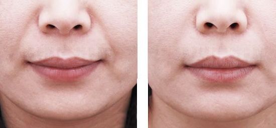 重慶藝星王永久醫(yī)生雙眼皮效果如何？90天招牌案例公開揭曉