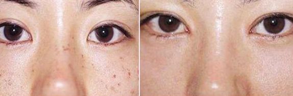 排名前五的廣醫(yī)二院雙眼皮醫(yī)生，價(jià)格參考2023