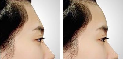 【2023年最受歡迎的福州鼻部整形醫(yī)生排行榜，效果口碑和價格點評】