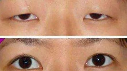 金華麗都整形為您呈現(xiàn)：雙眼皮神奇案例揭秘，專家力薦！