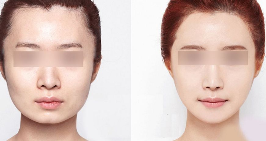 蚌埠三院美容科醫(yī)生推薦：疤痕修復案例分享與治療解析