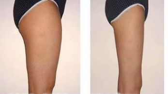 膨體隆鼻的潛在風(fēng)險與并發(fā)癥探討