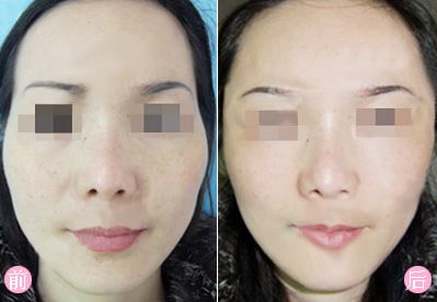 十堰黃褐斑治療哪里專業(yè)？好去哪家醫(yī)院問一問