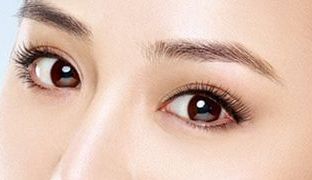 成都米蘭柏羽雙眼皮曝光！醫(yī)生做雙眼皮風格如何？對比照片供參考