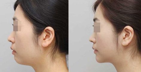 溫州優(yōu)質(zhì)修復(fù)整形醫(yī)院排行榜出爐！成就完美曲線，超高性價(jià)比驚艷推薦！