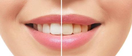 上海亞太整形醫(yī)院2023年隆鼻案例發(fā)布，廣受好評(píng)！