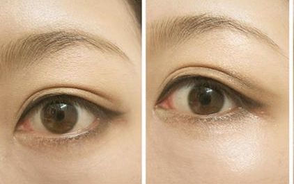 沈燕華醫(yī)生雙眼皮技術(shù)值得信賴，術(shù)后效果受到患者一致好評！