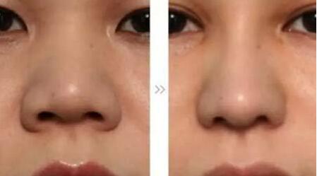 哪位醫(yī)生在全國范圍內(nèi)的脂肪填充領(lǐng)域技術(shù)比較好？