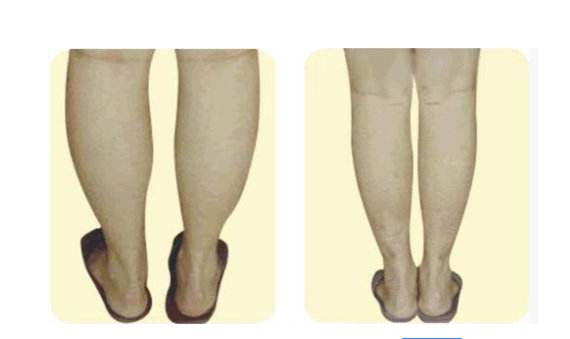 福州雷雪華醫(yī)生打造的鼻子效果如何？醫(yī)生實力及案例揭示