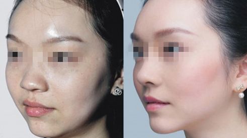 臺(tái)州哪家醫(yī)院治療乳頭矯正效果好？