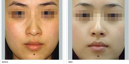 臺州狐臭治療中哪家醫(yī)院效果好？