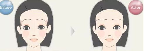 浙江哪家醫(yī)院眼袋祛除效果好？