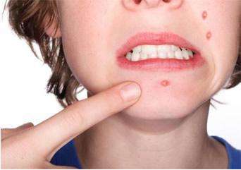 杭州哪些醫(yī)院以祛痣技術著稱？祛痣術在杭州受歡迎嗎？