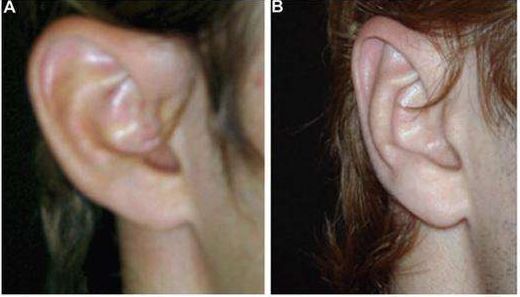 新疆隆胸術(shù)式解析：假體與自體脂肪隆胸優(yōu)劣對比