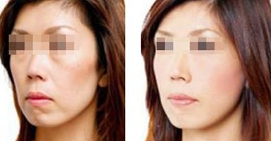 果酸祛痘間隔多久做一次？效果不明顯怎么辦？