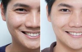 磨骨手術：價格差異與影響因素