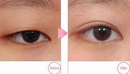 青島市立醫(yī)院雙眼皮割哪位醫(yī)生技術(shù)精湛？附案例和價(jià)格表參考