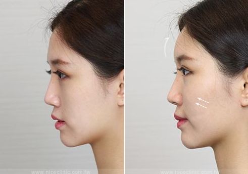 上海九院哪位醫(yī)生在人氣專家榜單上表現(xiàn)出色，值得面部提升患者青睞？