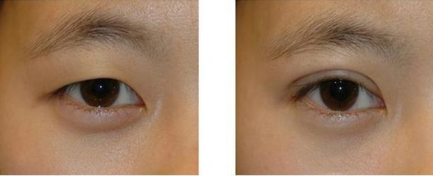 秦永平醫(yī)生雙眼皮手術(shù)效果如何？優(yōu)美案例圖賞