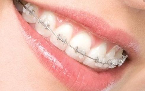 長沙瑞瀾李增產(chǎn)雙眼皮效果揭曉，2023最新案例揭露