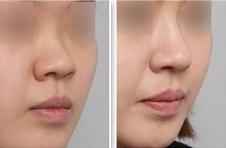 杭州最受歡迎的胸部整容整形醫(yī)院排行榜揭曉，網(wǎng)友推薦眾多醫(yī)院，有沒有熟悉的？