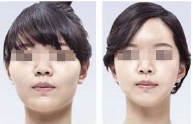 前額中部提眉術(shù)效果評測