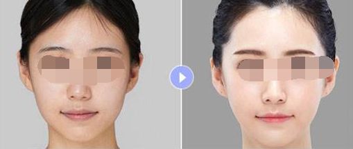 廣州哪家隆胸整形醫(yī)院好？排名大揭曉！