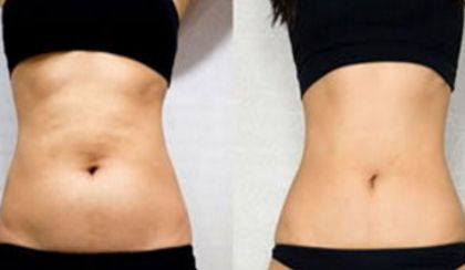 深圳有哪位醫(yī)生被推薦做拉皮手術(shù)？曹孟君、文豐值得考慮！