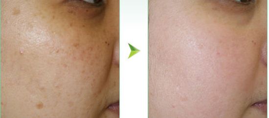 美萊西安王洪醫(yī)生的縮胸手術(shù)如何？附成功案例參考