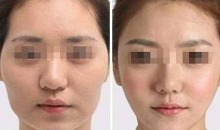 揭秘北京東方和諧脂肪填充真容，真實(shí)案例展示精湛技藝！