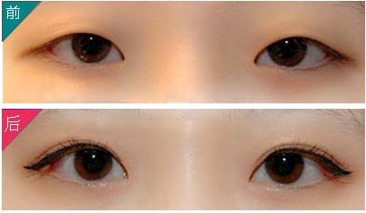 紹興有專業(yè)的肥胖科醫(yī)生，實(shí)力一流的技術(shù)吸引關(guān)注！快來看看大腿吸脂成功案例！