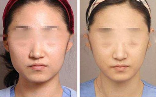 廣州下頜角手術(shù)哪家醫(yī)院比較靠譜？