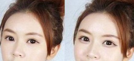 注射伊維蘭隆鼻，多久恢復消腫效果好？